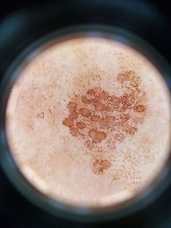 pigmentation spot