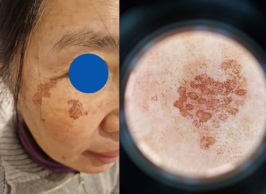 pigment in sun-spots