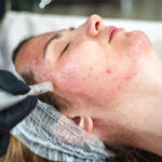 AcneTreatment1