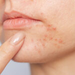 AcneTreatment10 (1)