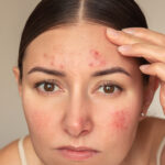 AcneTreatment11 (1)