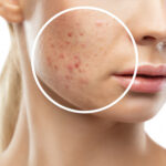 AcneTreatment2