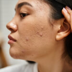 AcneTreatment3