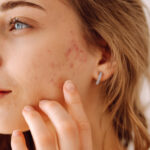 AcneTreatment9