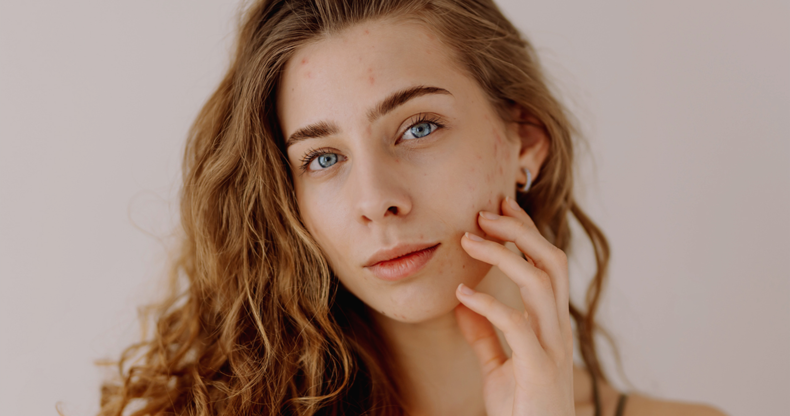 HeroImage_AcneTreatment