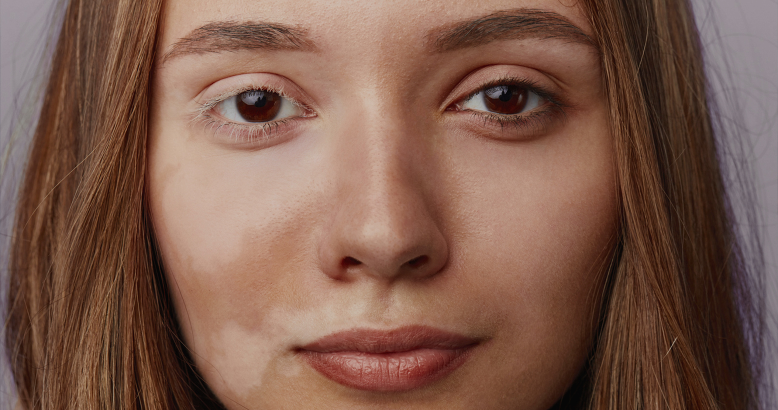 HeroImage_LaserPigmentationTreatment