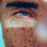 LaserPigmentation1