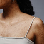 LaserPigmentation2