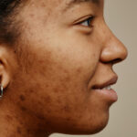 LaserPigmentation3