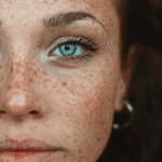 LaserPigmentation4