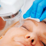 LaserTreatment1 (1)