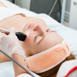 LaserTreatment2